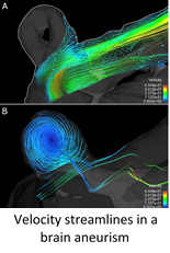 Velocity streamlines in a brain aneurism
