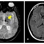 Microbleeds and intracerebral hemorrhage in COL4A1-related SVD